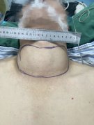 【福德甲乳】甲亢、巨大甲状腺肿成功手术