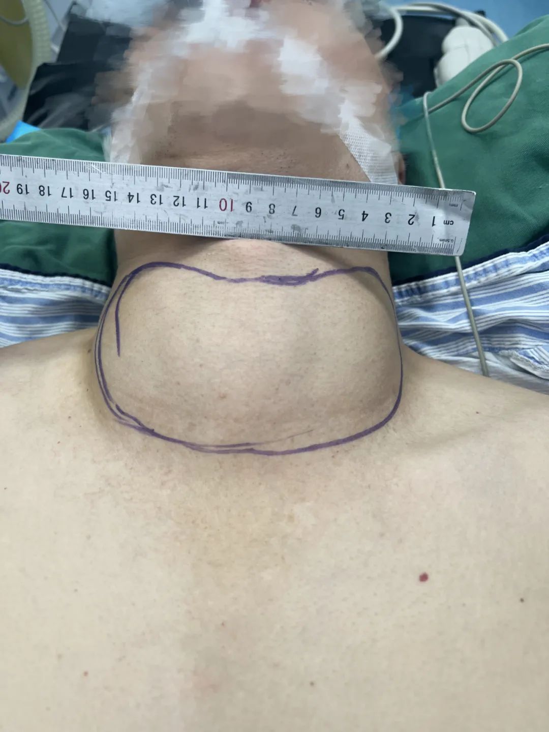 【福德甲乳】甲亢、巨大甲状腺肿成功手术