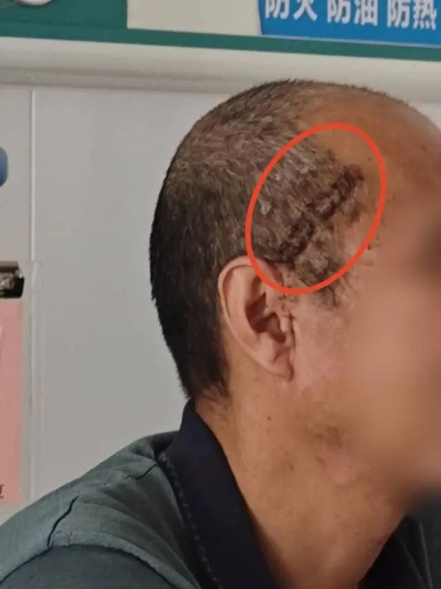【耳鼻喉科】强强联合！多学科团队微创复位颧弓骨折