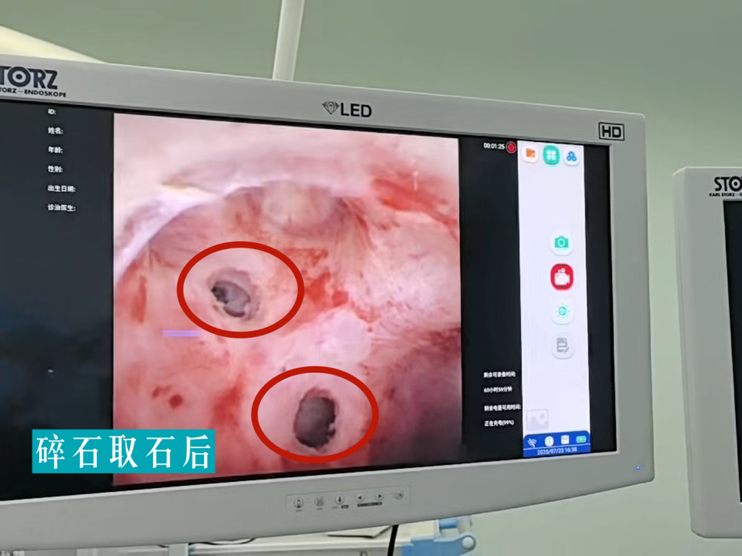 【福德泌尿】结石治疗新选择！一根“软镜”无创碎石！