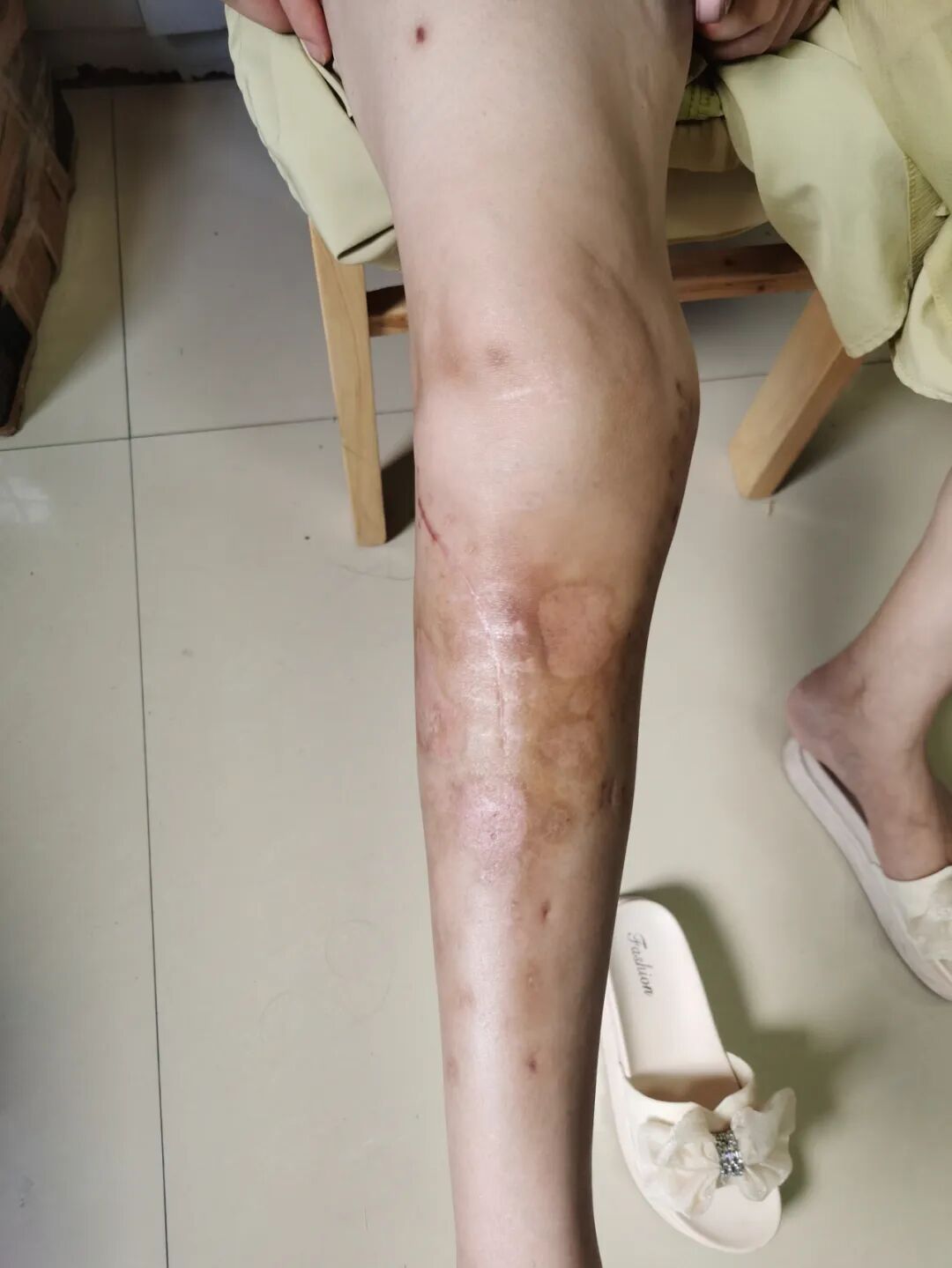 【福德康复】无痛疗愈新选择——中药外敷