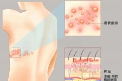 【福德康复】中医火针,助您告别“缠腰龙”之痛!