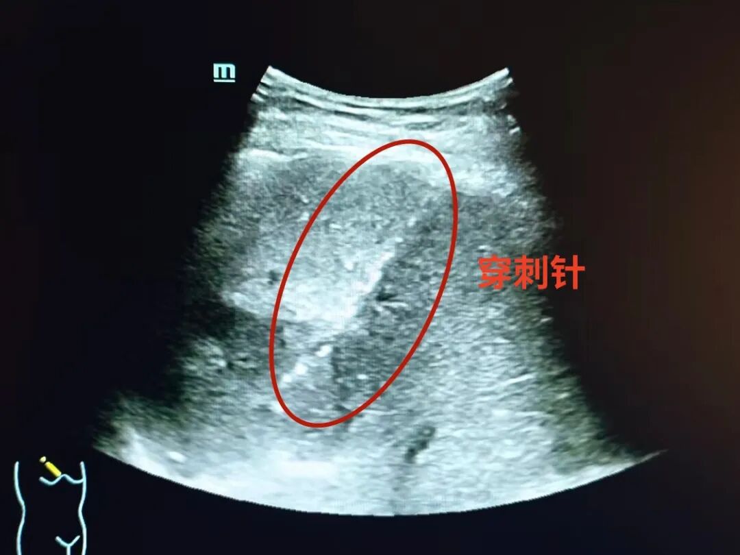 【超声介入】一根细管“穿”破危局！福德医院多学科协作精准守护生命