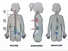 【福德康复】抓住寒假窗口！青少年脊柱侧弯矫正别拖延！